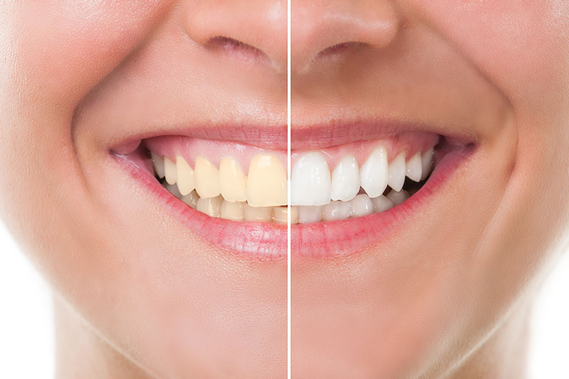 Teeth Whitening - PC Family Dentistry, Diamond Bar Dentist
